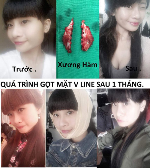 'Cô gái xấu xí' Chippy Pola tiết lộ quá trình gọt hàm - 2