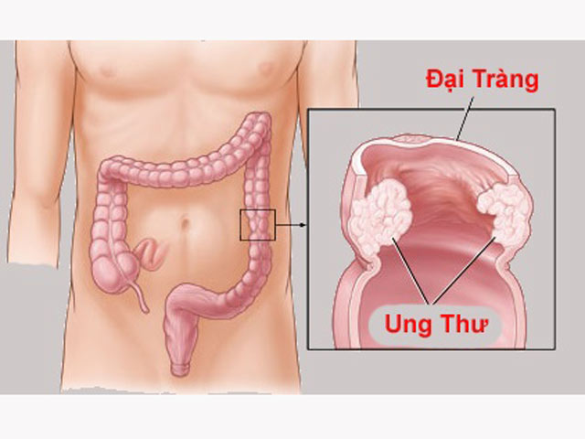 Cách thoát khỏi viêm đại tràng mạn tính - 1