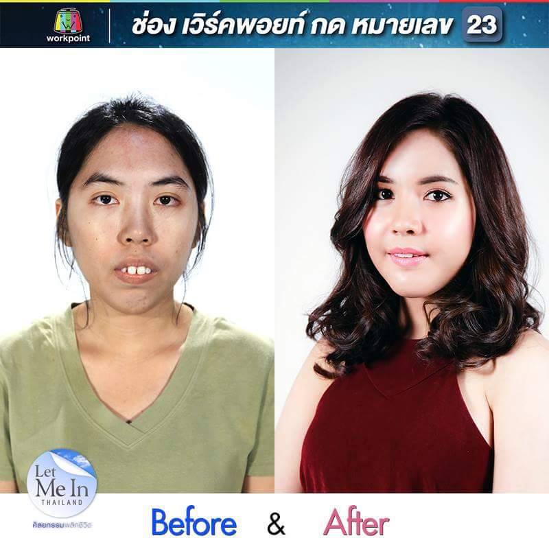 Cô gái Thái Lan răng hô &#39;lột xác&#39; bất ngờ nhờ thẩm mỹ - 1