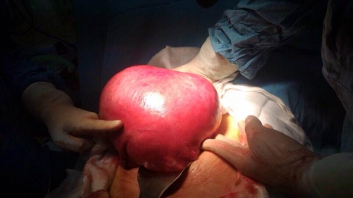 Phát hoảng nhìn khối u bằng quả bóng được lấy ra từ người phụ nữ - 1