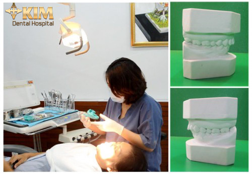 Bọc răng sứ không cần mài răng tại Bệnh viện Răng Hàm Mặt - 2