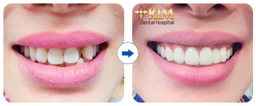Bọc răng sứ không cần mài răng tại Bệnh viện Răng Hàm Mặt - 3