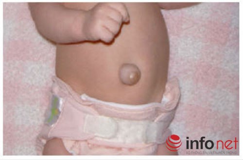 Rốn con tự nhiên lồi lên là bệnh gì? - 1
