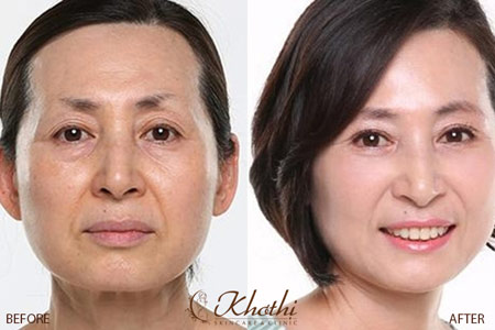 3 ngày trợ giá căng da bằng chỉ vàng với bác sĩ Singapore - 3