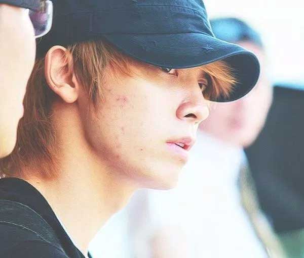 11 mỹ nam, mỹ nữ Hàn có làn da bị "giặc mụn" tàn phá - 5