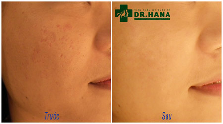 Ưu đãi sốc: Giảm tới 83% cho dịch vụ thẩm mỹ ngày 8/3 - 5