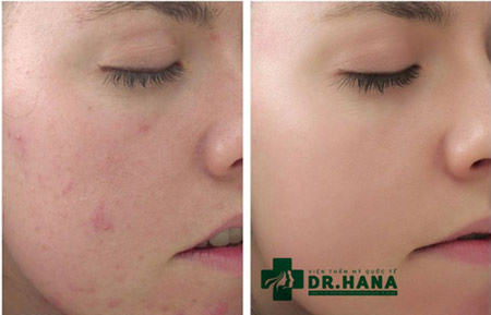 Ưu đãi sốc: Giảm tới 83% cho dịch vụ thẩm mỹ ngày 8/3 - 6