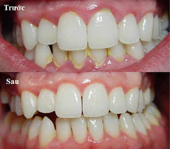 Cạo vôi răng miễn phí tại Bệnh viện Thẩm mỹ JW Hàn Quốc - 6