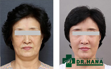 Ưu đãi sốc: Giảm tới 83% cho dịch vụ thẩm mỹ ngày 8/3 - 2