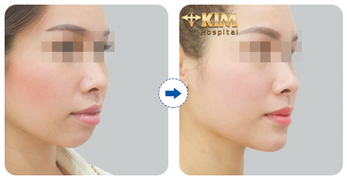 Độn cằm, trượt cằm không lo về giá nhân dịp 8/3 - 4