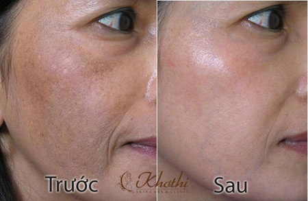 4 cách trị nám hiệu quả từ thiên nhiên - 3