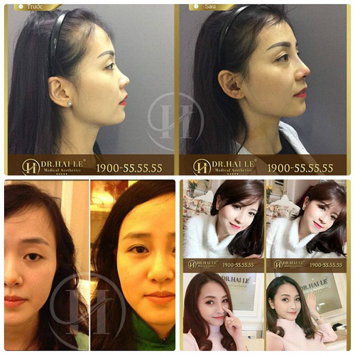 Dr. Hải Lê miễn phí nâng mũi S-Line 2 lớp trị giá 28 triệu cho 100 khách hàng - 2