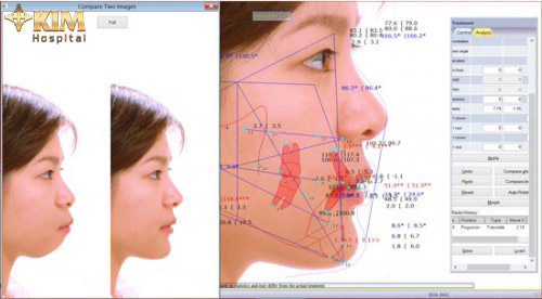 Tường tận phương pháp hạ gò má cao - 4