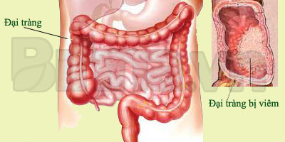Giải pháp của người Nhật giúp nhiều người thoát khỏi viêm đại tràng - 1