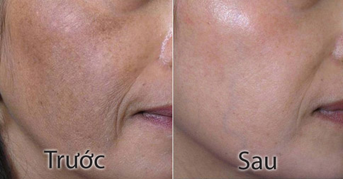 Nám và tàn nhang khác nhau như thế nào, làm sao để điều trị? - 2