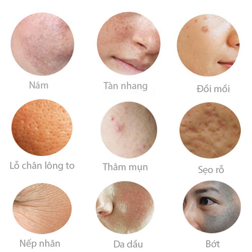 Nám và tàn nhang khác nhau như thế nào, làm sao để điều trị? - 3