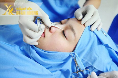 Làm thế nào để khắc phục nhược điểm mũi xấu nhanh nhất? - 2