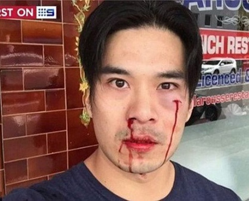 Diễn viên Việt bị đánh chảy máu trên đường phố Úc - 1