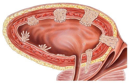 Những người có khối u ở vị trí này, 90% sẽ mắc ung thư - 1