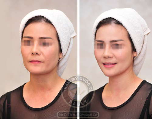 Việt Kiều về quê làm đẹp đón Tết - 5