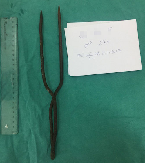 Hy hữu: Thanh sắt xiên cá đâm thủng 6 lỗ trên tim, vẫn sống - 2