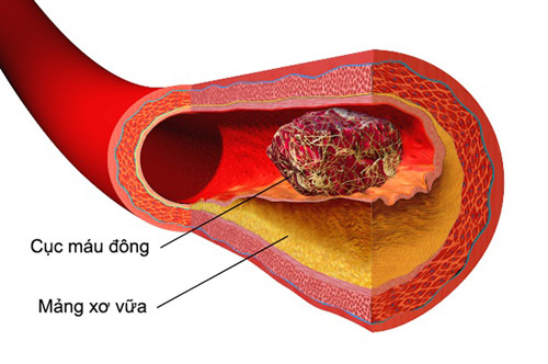 Nặng đầu, đau đầu, khó ngủ coi chừng tai biến, liệt người - 2