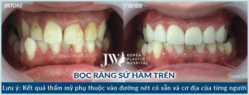 “Phát sốt” với phương pháp làm đẹp răng thần tốc - 2