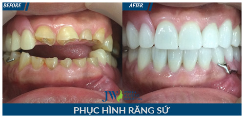 “Phát sốt” với phương pháp làm đẹp răng thần tốc - 3