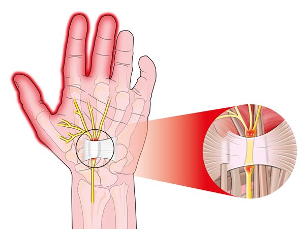 Vì sao bạn hay bị tê, ngứa ở bàn tay, chân, hồi hộp, khó thở và táo bón? - 2