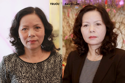 Sự thật đằng sau phương pháp trị nám đang “gây sốt” tại Hà thành - 1