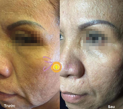 Ưu đãi 76% giải pháp nâng cơ mặt 60 phút không phẫu thuật - 2