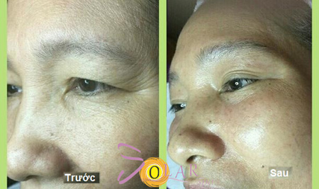 Ưu đãi 76% giải pháp nâng cơ mặt 60 phút không phẫu thuật - 3