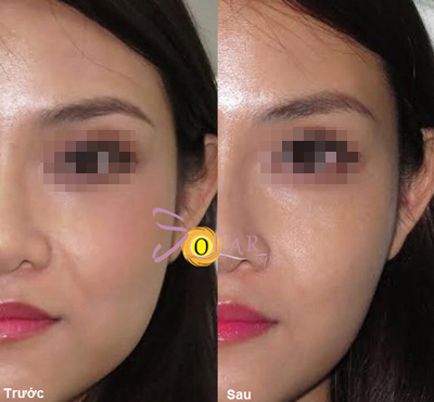 Ưu đãi 76% giải pháp nâng cơ mặt 60 phút không phẫu thuật - 4