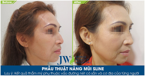 Phẫu thuật miễn phí với “cha đẻ” của phương pháp nâng mũi S-Line - 6