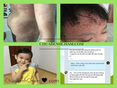 Bài thuốc nam độc đáo điều trị bệnh tổ đỉa, á sừng - 3