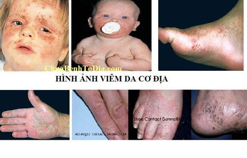 Bài thuốc nam độc đáo điều trị bệnh tổ đỉa, á sừng - 4