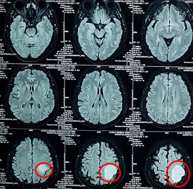 Một phụ nữ có khối u não to như trái bóng tennis - 1