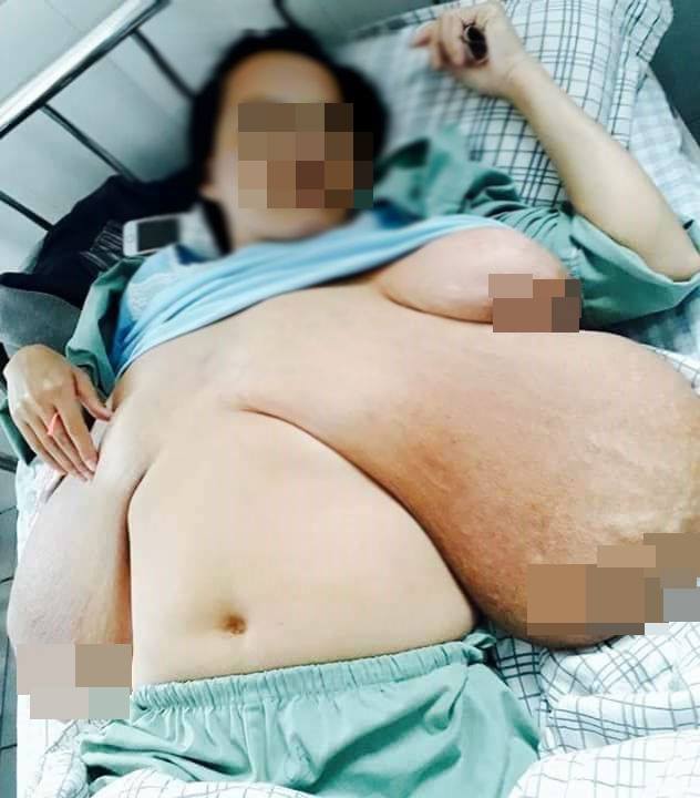 Bộ ngực khổng lồ của người phụ nữ ở Phú Thọ có to lại nếu được phẫu thuật? - 1