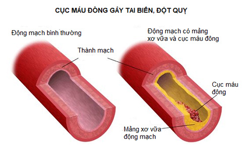 8 ngộ nhận chết người về tai biến mà người Việt rất hay mắc phải - 2