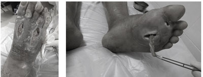 Người tiểu đường không lo cắt cụt chi nhờ phương pháp này - 1