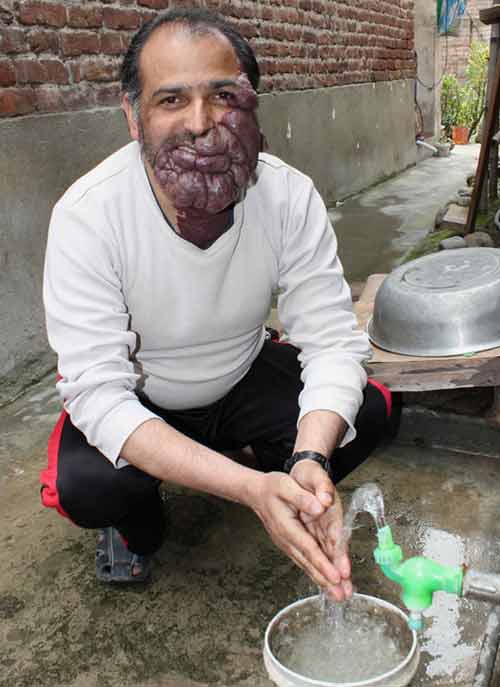 Người đàn ông với khối u khổng lồ trên mặt - 2