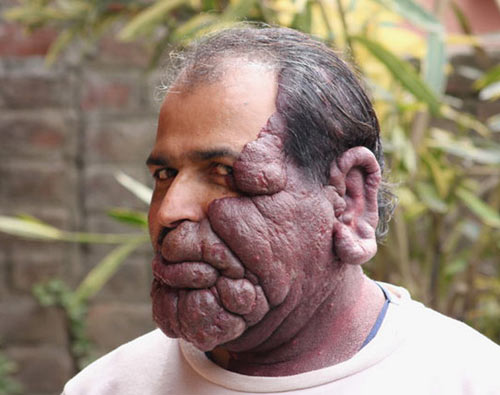 Người đàn ông với khối u khổng lồ trên mặt - 3