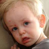 Sức khỏe đời sống - Cách điều trị ban nhiệt ở trẻ