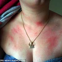 Sức khỏe đời sống - Dị ứng mùa nóng, chữa thế nào?