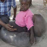 Sức khỏe đời sống - Cậu bé "chân voi" 10 năm chỉ mặc váy