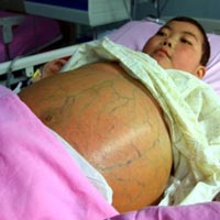 Phi thường - kỳ quặc - Bé trai có... "bụng bầu" khổng lồ