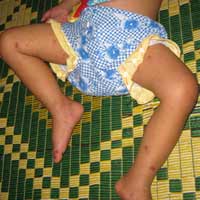 Sức khỏe đời sống - Đã có bệnh nhi mắc viêm não mô cầu