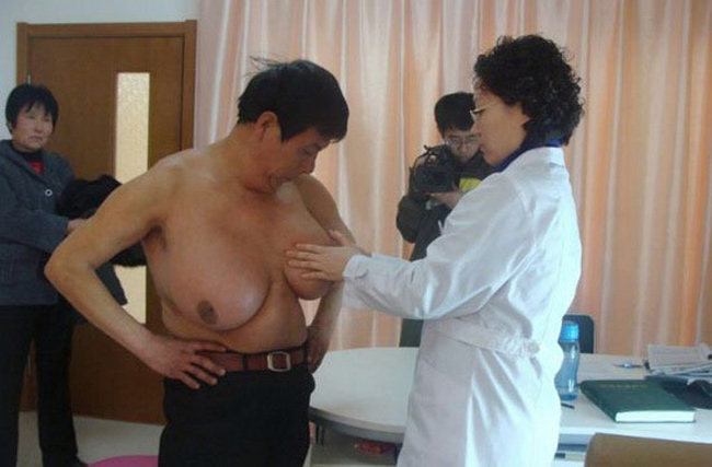 4. Cũng có một câu chuyện lạ đặc biệt khác về vòng một của nam giới. Đó là ông Quách Phong, hơn 50 tuổi, một nông dân Trung Quốc, lập kỷ lục là Người đàn ông có bộ ngực lớn nhất thế giới.