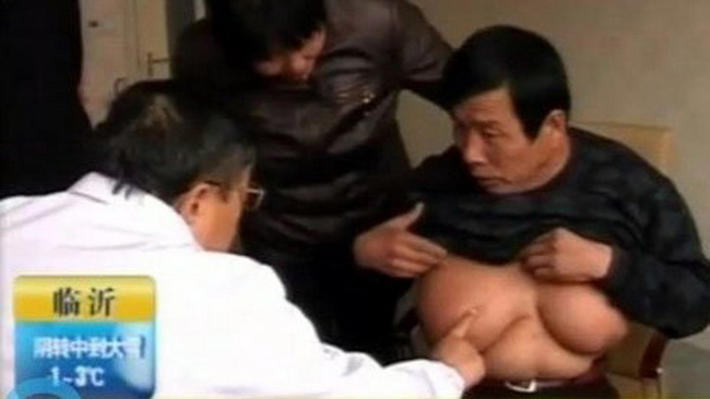 Hiện giờ các bác sĩ vẫn đang tìm hiểu nguyên nhân căn bệnh to ngực của ông Quách Phong.