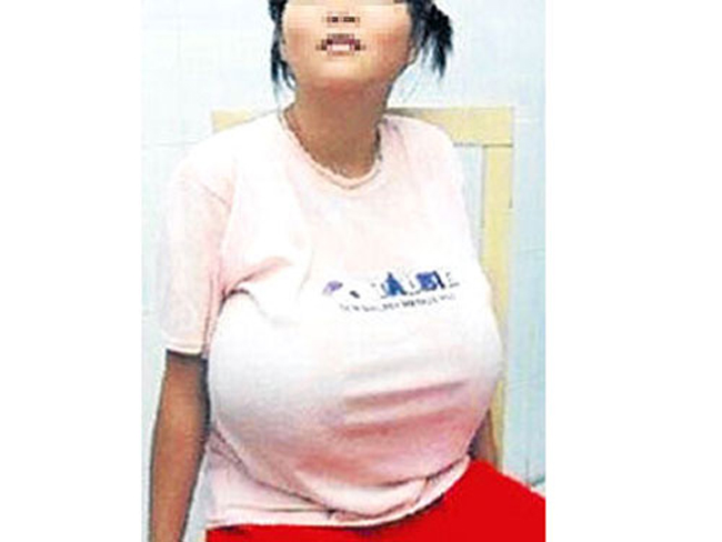 9. Cô gái Singapore có bộ ngực quá lớn đã gặp không ít phiền hà. Theo bác sĩ, cô bị mắc chứng bệnh to ngực, tên chuyên môn là macromastia.